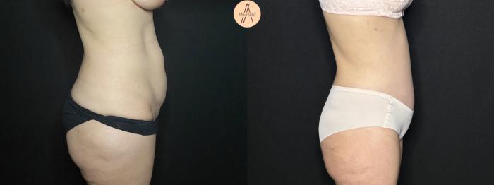 Before & After Tummy Tuck Case 254 Right Side View in San Antonio, Texas