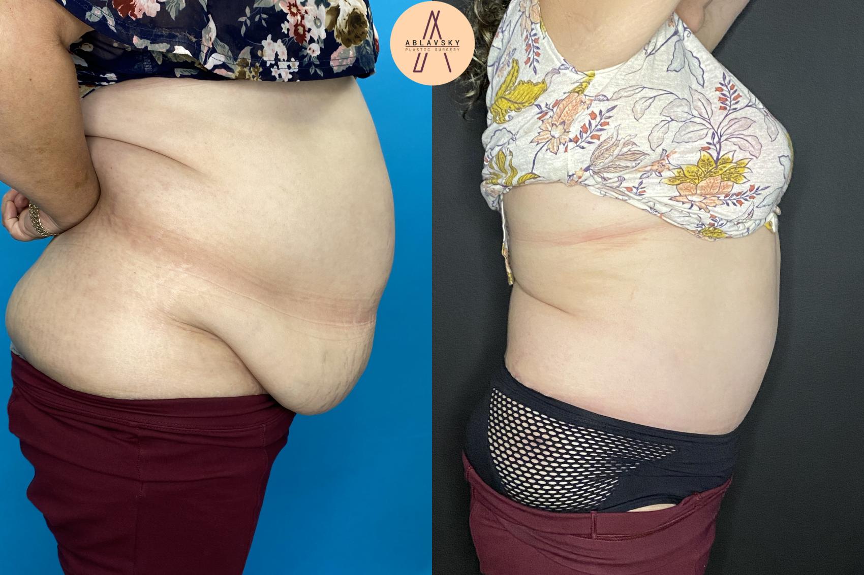 Before & After Tummy Tuck Case 27 Back View in San Antonio, Texas
