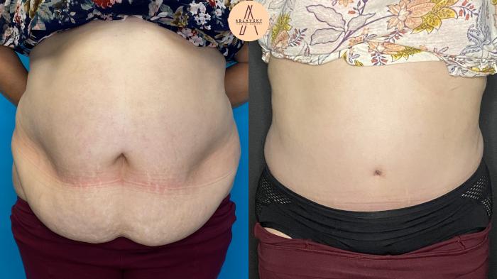 Before & After Tummy Tuck Case 27 Front View in San Antonio, Texas