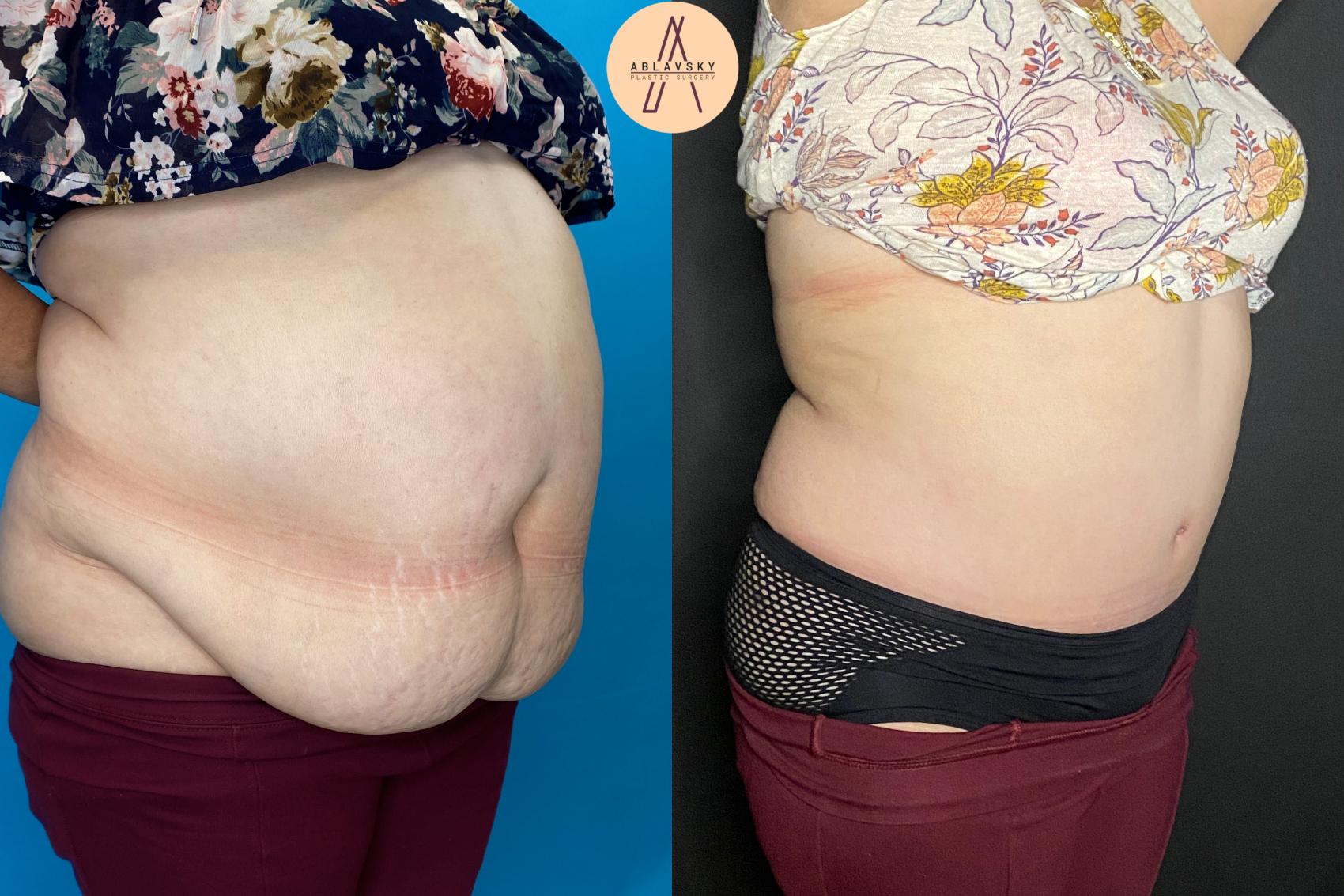 Before & After Tummy Tuck Case 27 Right Oblique View in San Antonio, Texas