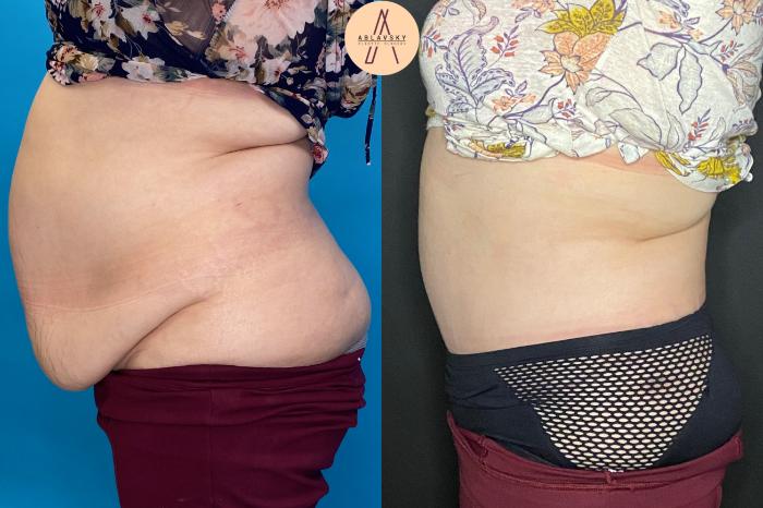 Before & After Tummy Tuck Case 27 Right Side View in San Antonio, Texas