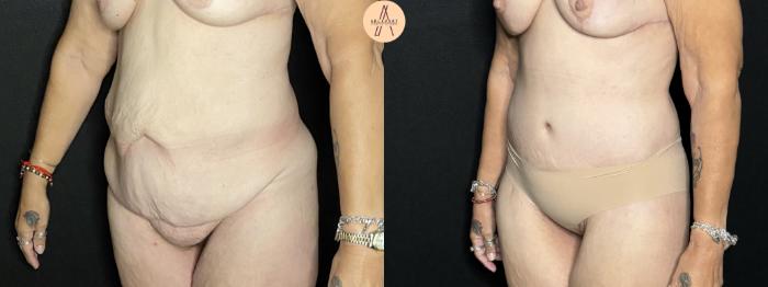 Before & After Tummy Tuck Case 271 Left Oblique View in San Antonio, Texas