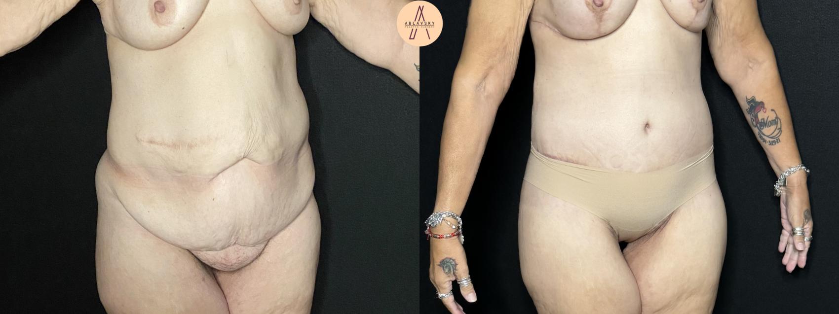 Before & After Tummy Tuck Case 271 Right Oblique View in San Antonio, Texas
