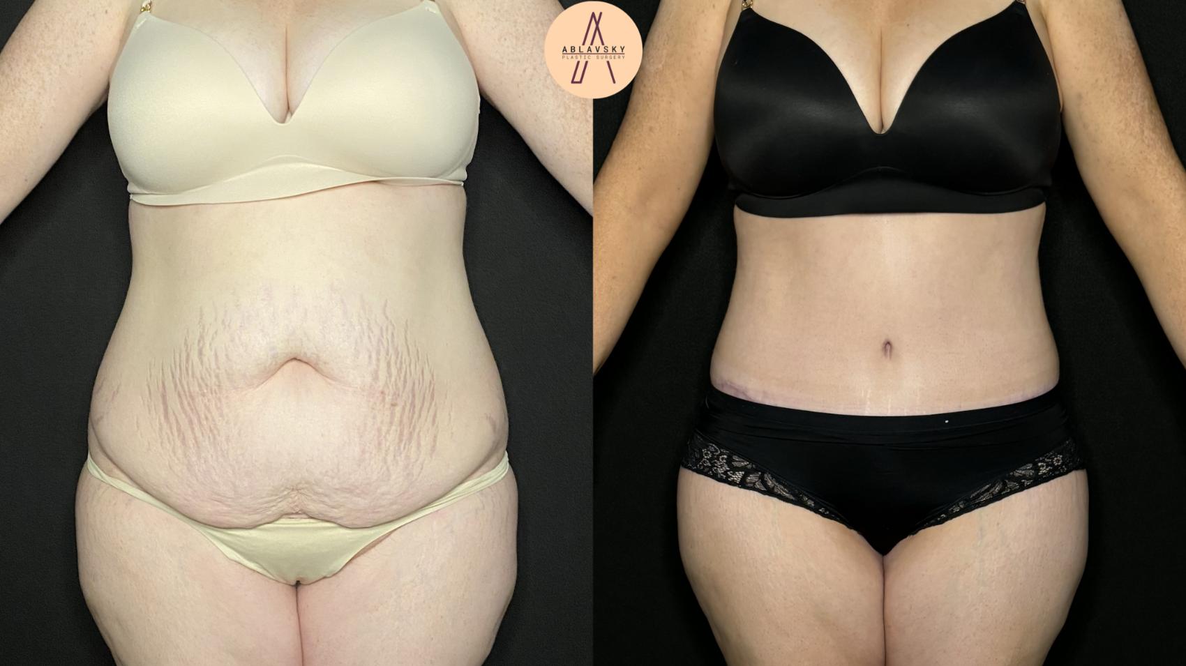 Before & After Tummy Tuck Case 273 Front View in San Antonio, Texas