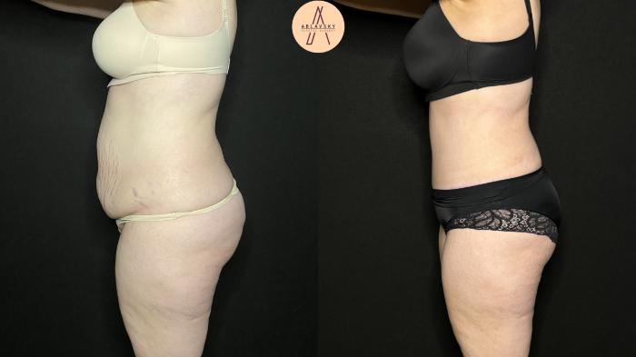 Before & After Tummy Tuck Case 273 Left Side View in San Antonio, Texas