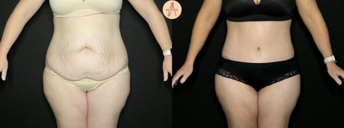 Before & After Tummy Tuck Case 274 Front View in San Antonio, Texas