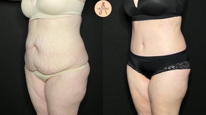 Before & After Tummy Tuck Case 274 Left Oblique View in San Antonio, Texas