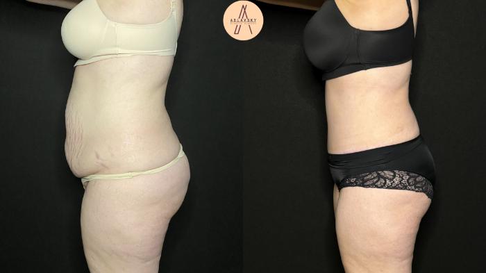 Before & After Tummy Tuck Case 274 Left Side View in San Antonio, Texas