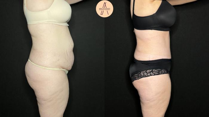 Before & After Tummy Tuck Case 274 Right Side View in San Antonio, Texas