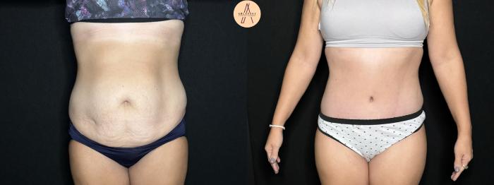 Before & After Tummy Tuck Case 276 Front View in San Antonio, Texas