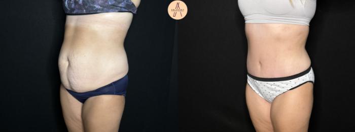 Before & After Tummy Tuck Case 276 Left Oblique View in San Antonio, Texas