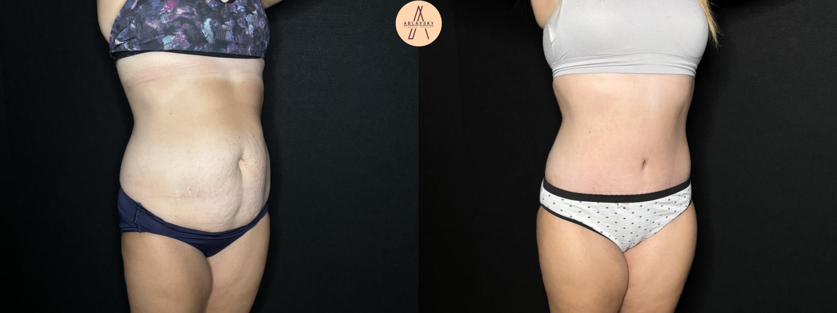 Before & After Tummy Tuck Case 276 Right Oblique View in San Antonio, Texas