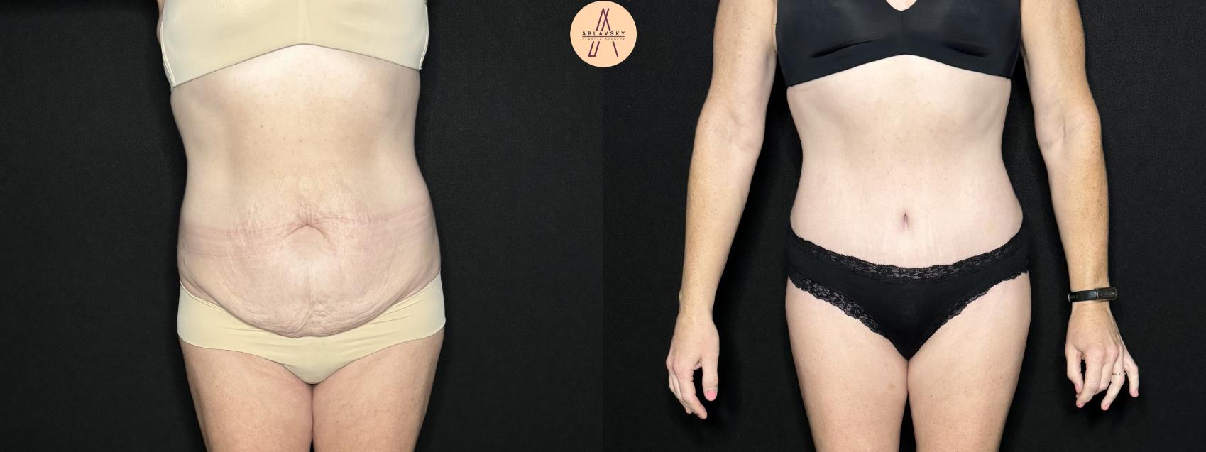 Before & After Tummy Tuck Case 277 Front View in San Antonio, Texas