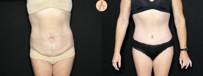 Before & After Tummy Tuck Case 277 Front View in San Antonio, Texas