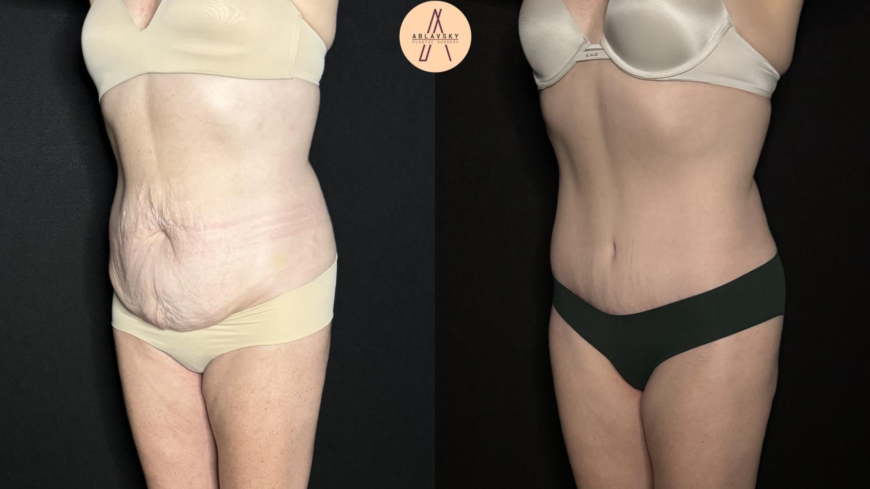 Before & After Tummy Tuck Case 277 Left Oblique View in San Antonio, Texas