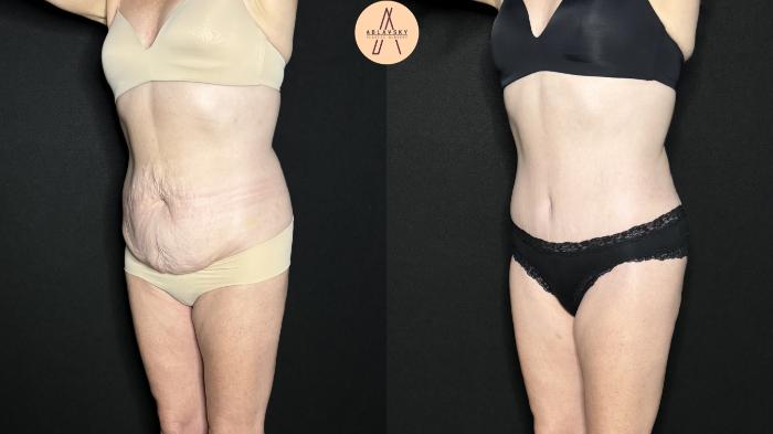 Before & After Tummy Tuck Case 277 Left Oblique View in San Antonio, Texas