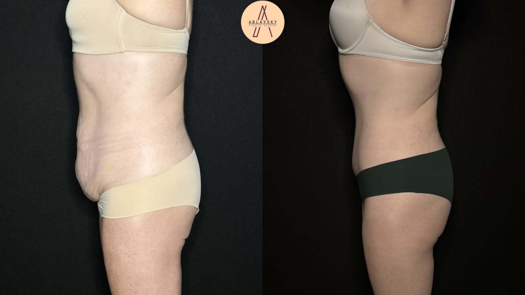 Before & After Tummy Tuck Case 277 Left Side View in San Antonio, Texas