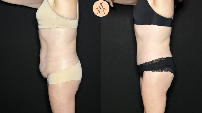 Before & After Tummy Tuck Case 277 Left Side View in San Antonio, Texas