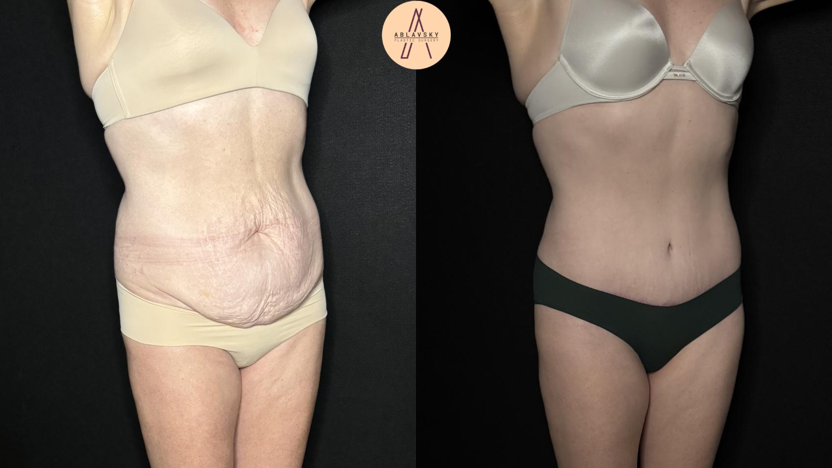 Before & After Tummy Tuck Case 277 Right Oblique View in San Antonio, Texas