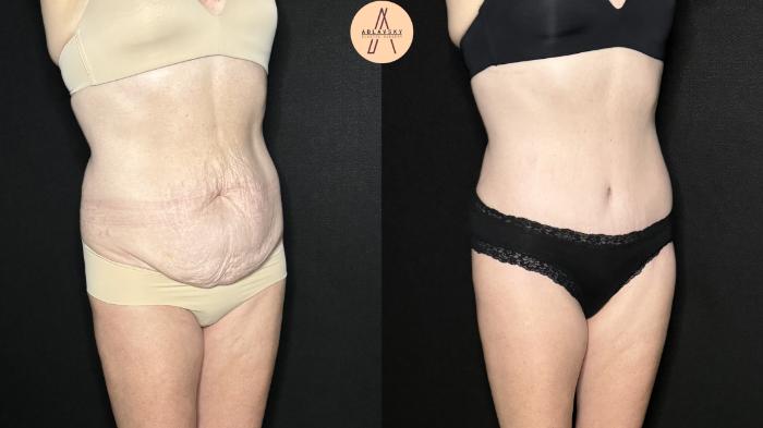 Before & After Tummy Tuck Case 277 Right Oblique View in San Antonio, Texas