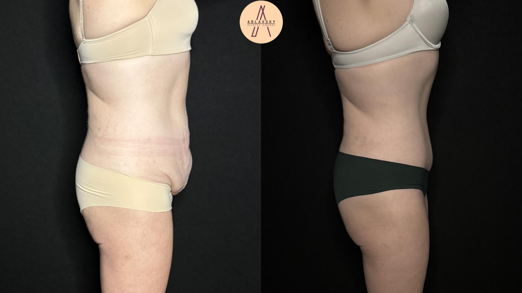 Before & After Tummy Tuck Case 277 Right Side View in San Antonio, Texas