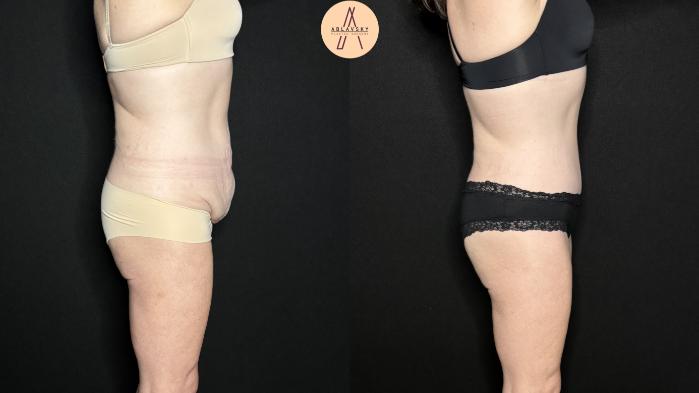 Before & After Tummy Tuck Case 277 Right Side View in San Antonio, Texas