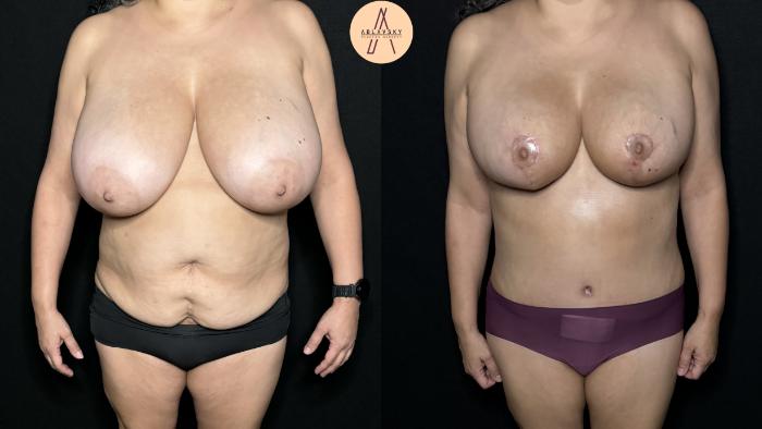 Before & After Tummy Tuck Case 300 Front View in San Antonio, Texas