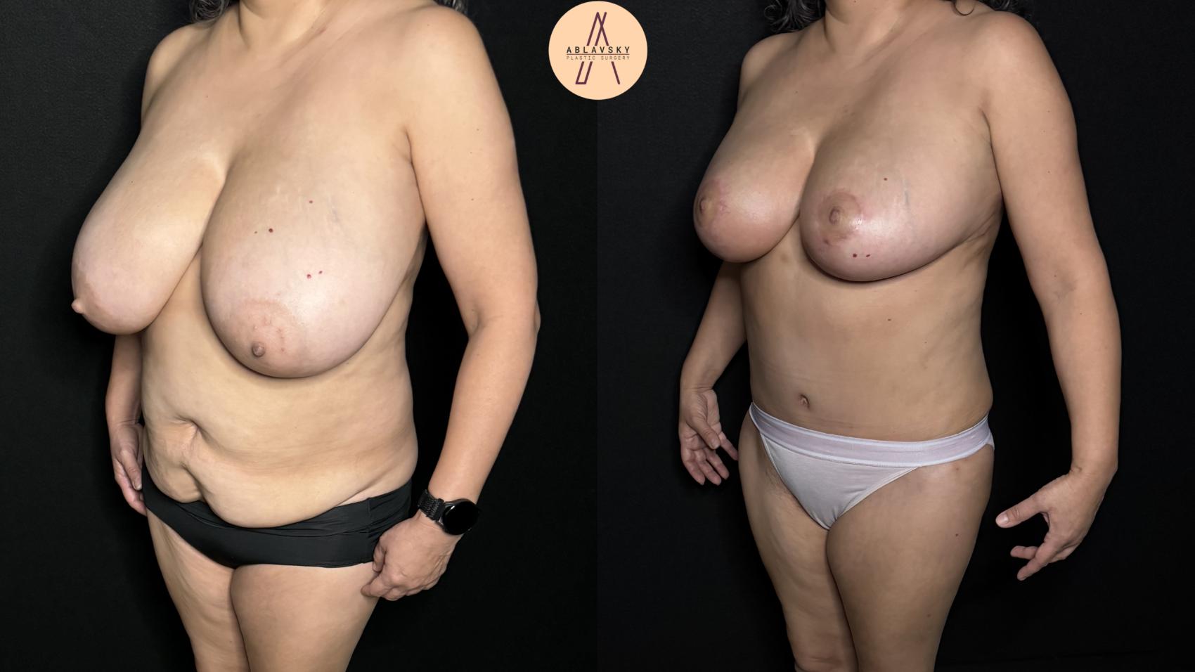 Before & After Mommy Makeover Case 300 Left Oblique View in San Antonio, Texas