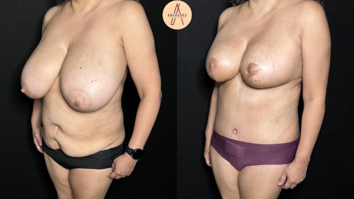 Before & After Tummy Tuck Case 300 Left Oblique View in San Antonio, Texas