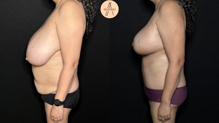 Before & After Tummy Tuck Case 300 Left Side View in San Antonio, Texas