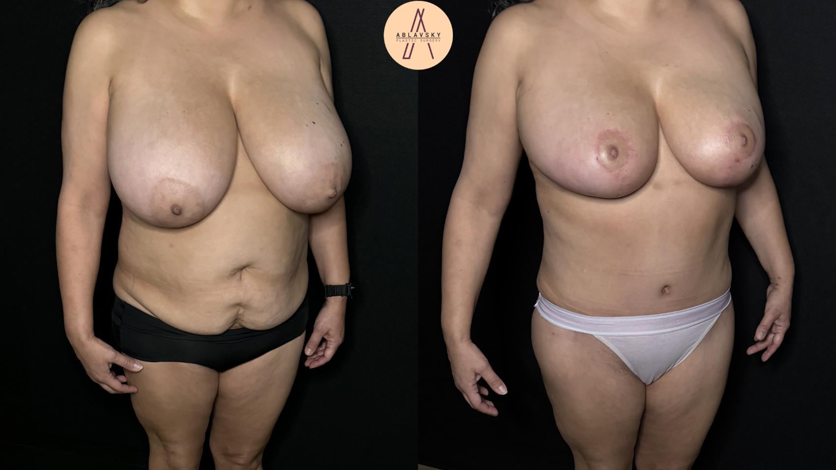 Before & After Mommy Makeover Case 300 Right Oblique View in San Antonio, Texas