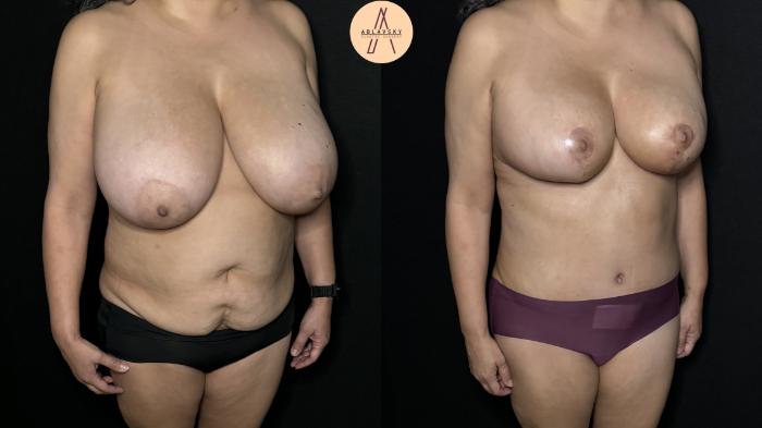 Before & After Tummy Tuck Case 300 Right Oblique View in San Antonio, Texas