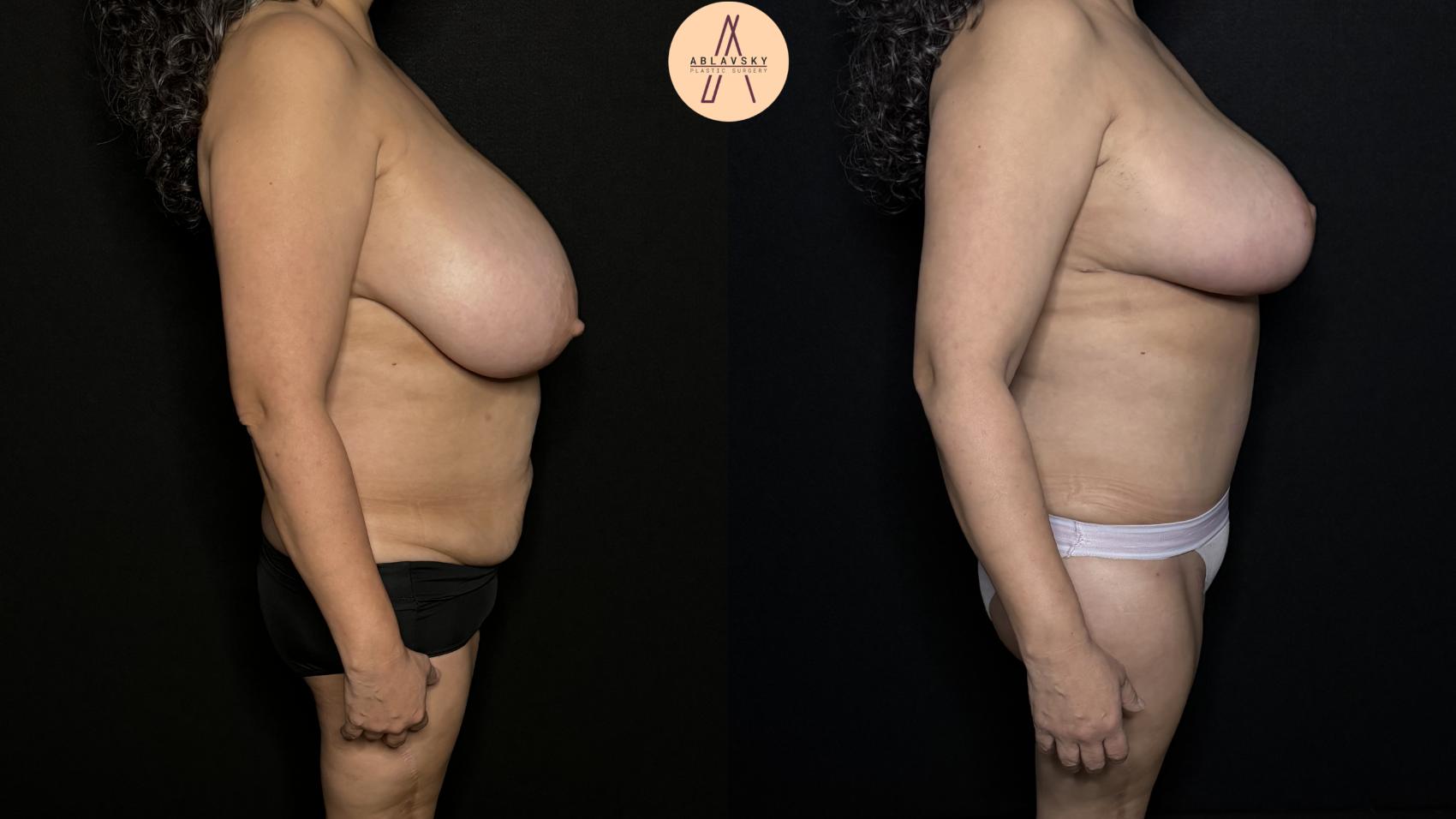 Before & After Mommy Makeover Case 300 Right Side View in San Antonio, Texas