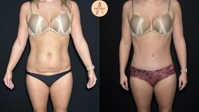 Before & After Tummy Tuck Case 302 Front View in San Antonio, Texas