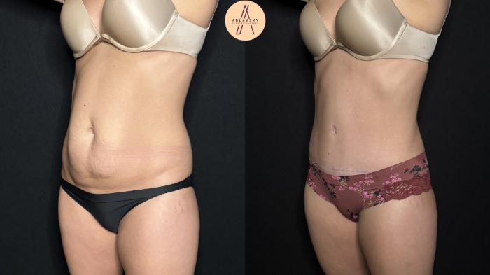 Before & After Tummy Tuck Case 302 Left Oblique View in San Antonio, Texas