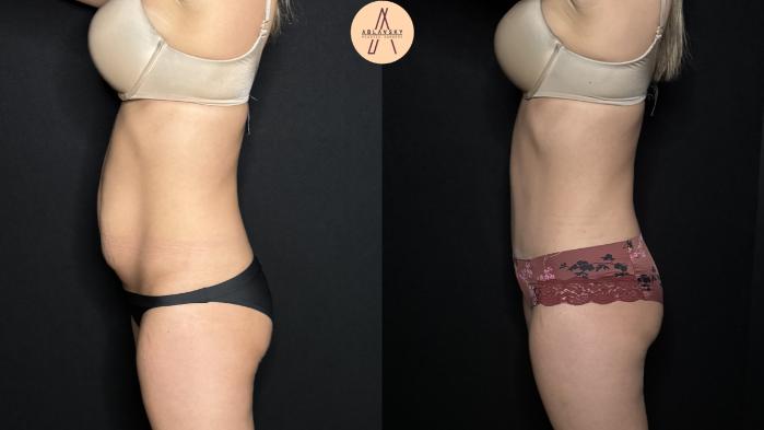 Before & After Tummy Tuck Case 302 Left Side View in San Antonio, Texas