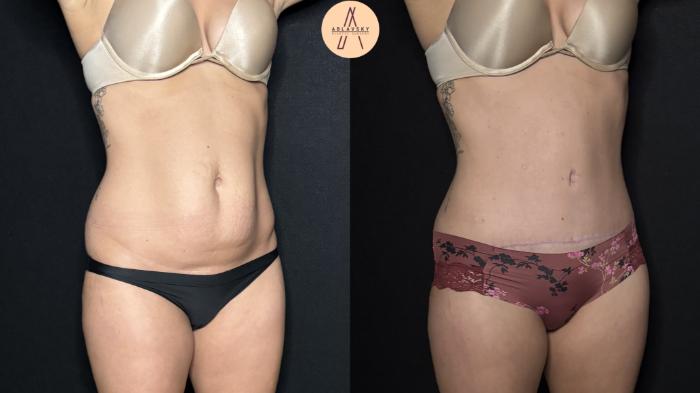 Before & After Tummy Tuck Case 302 Right Oblique View in San Antonio, Texas