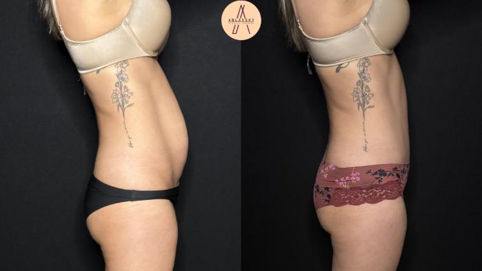 Before & After Tummy Tuck Case 302 Right Side View in San Antonio, Texas