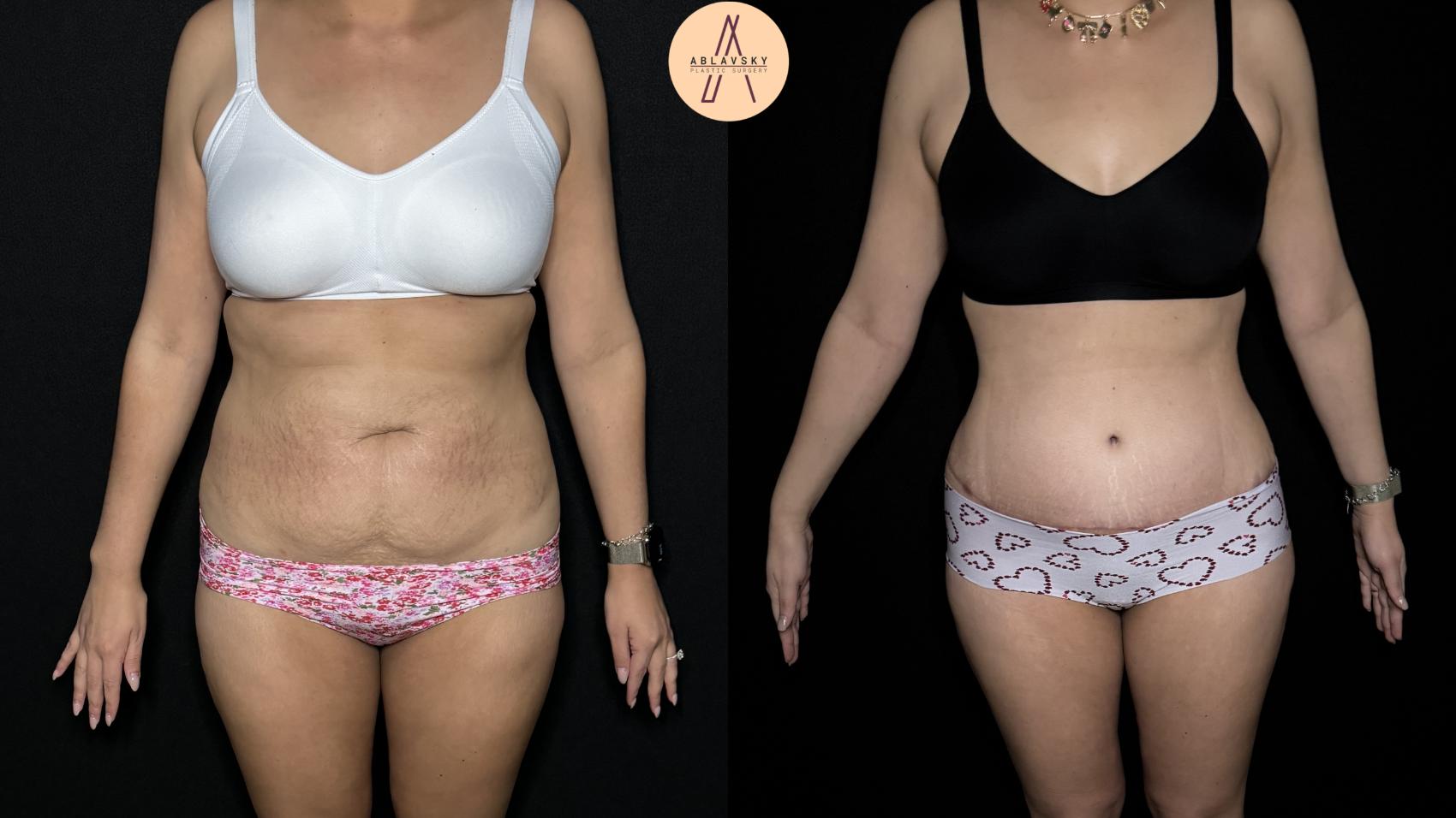 Before & After Tummy Tuck Case 305 Front View in San Antonio, Texas