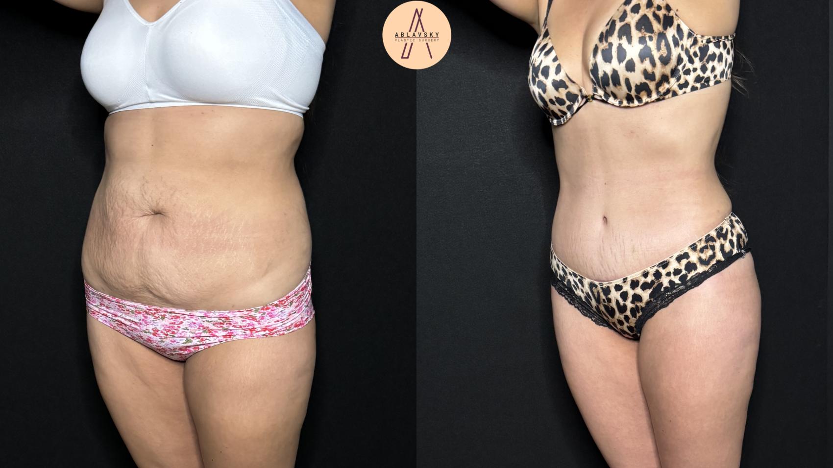 Before & After Tummy Tuck Case 305 Left Oblique View in San Antonio, Texas
