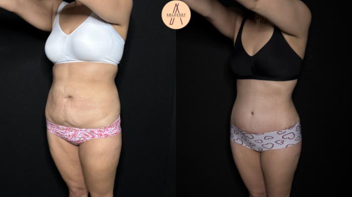 Before & After Tummy Tuck Case 305 Left Oblique View in San Antonio, Texas