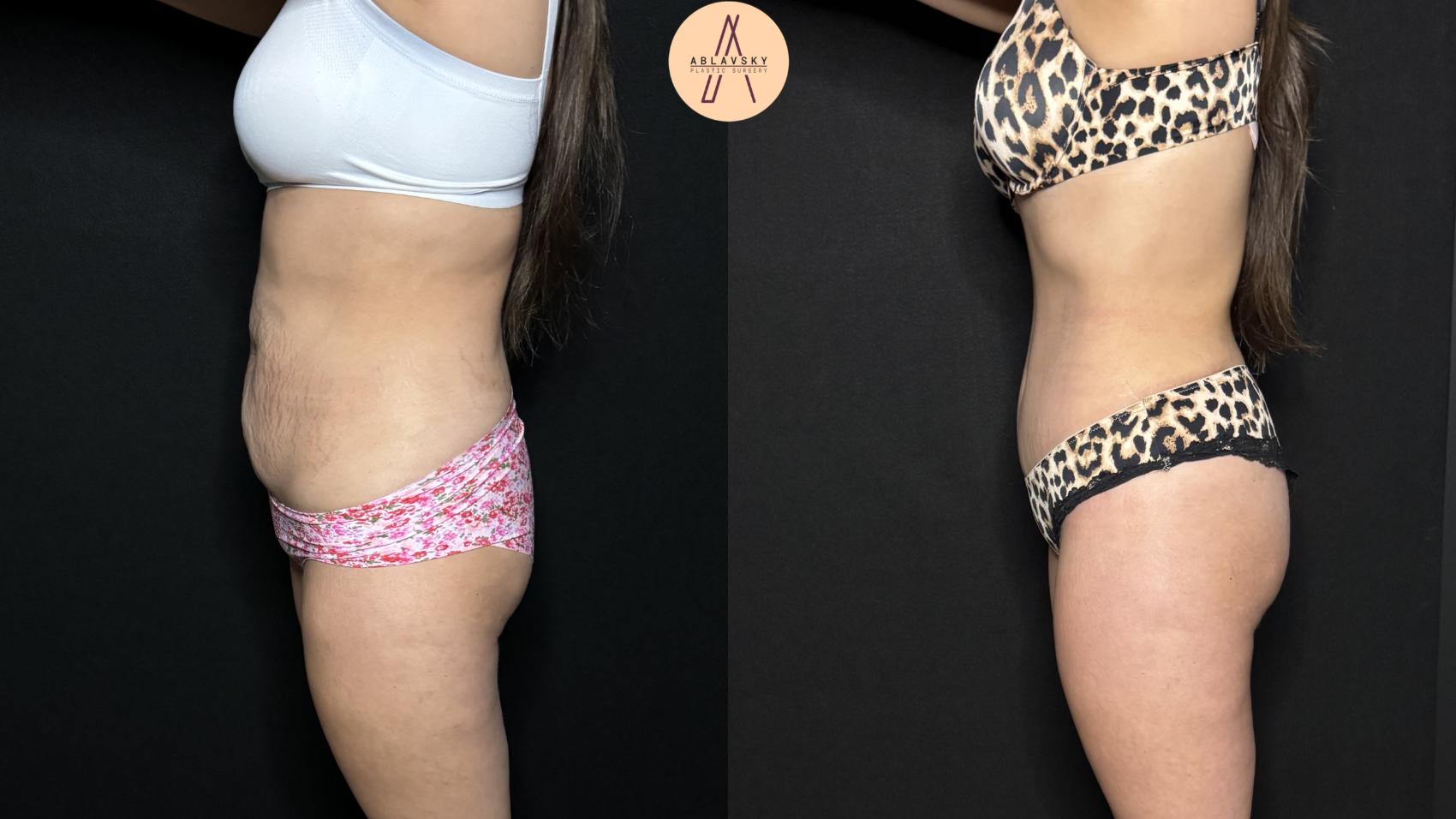 Before & After Tummy Tuck Case 305 Left Side View in San Antonio, Texas