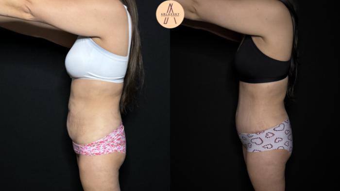 Before & After Tummy Tuck Case 305 Left Side View in San Antonio, Texas