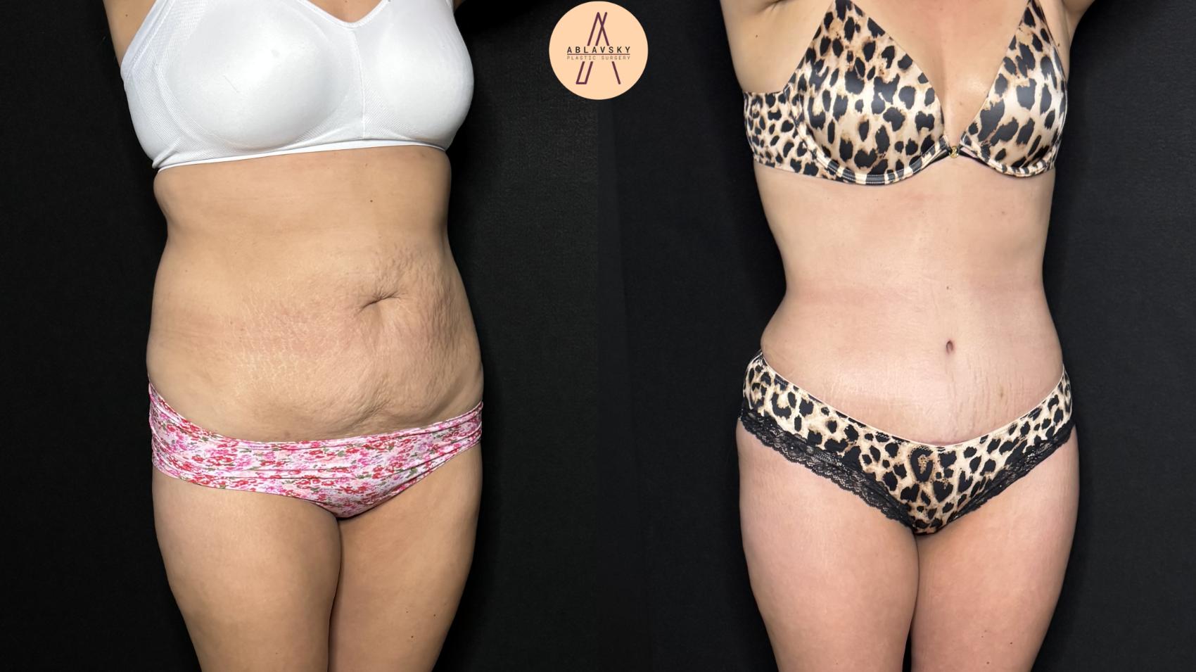 Before & After Tummy Tuck Case 305 Right Oblique View in San Antonio, Texas