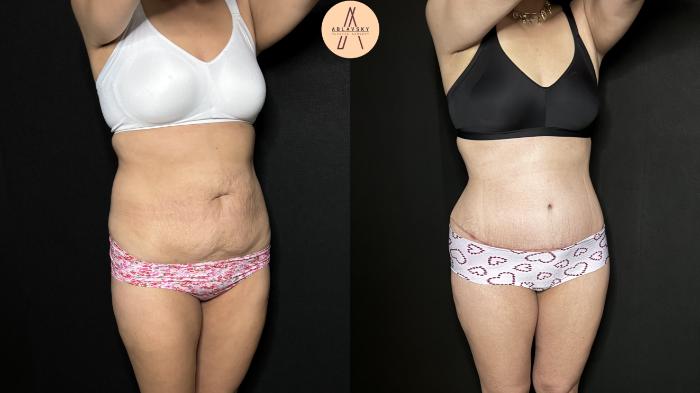 Before & After Tummy Tuck Case 305 Right Oblique View in San Antonio, Texas