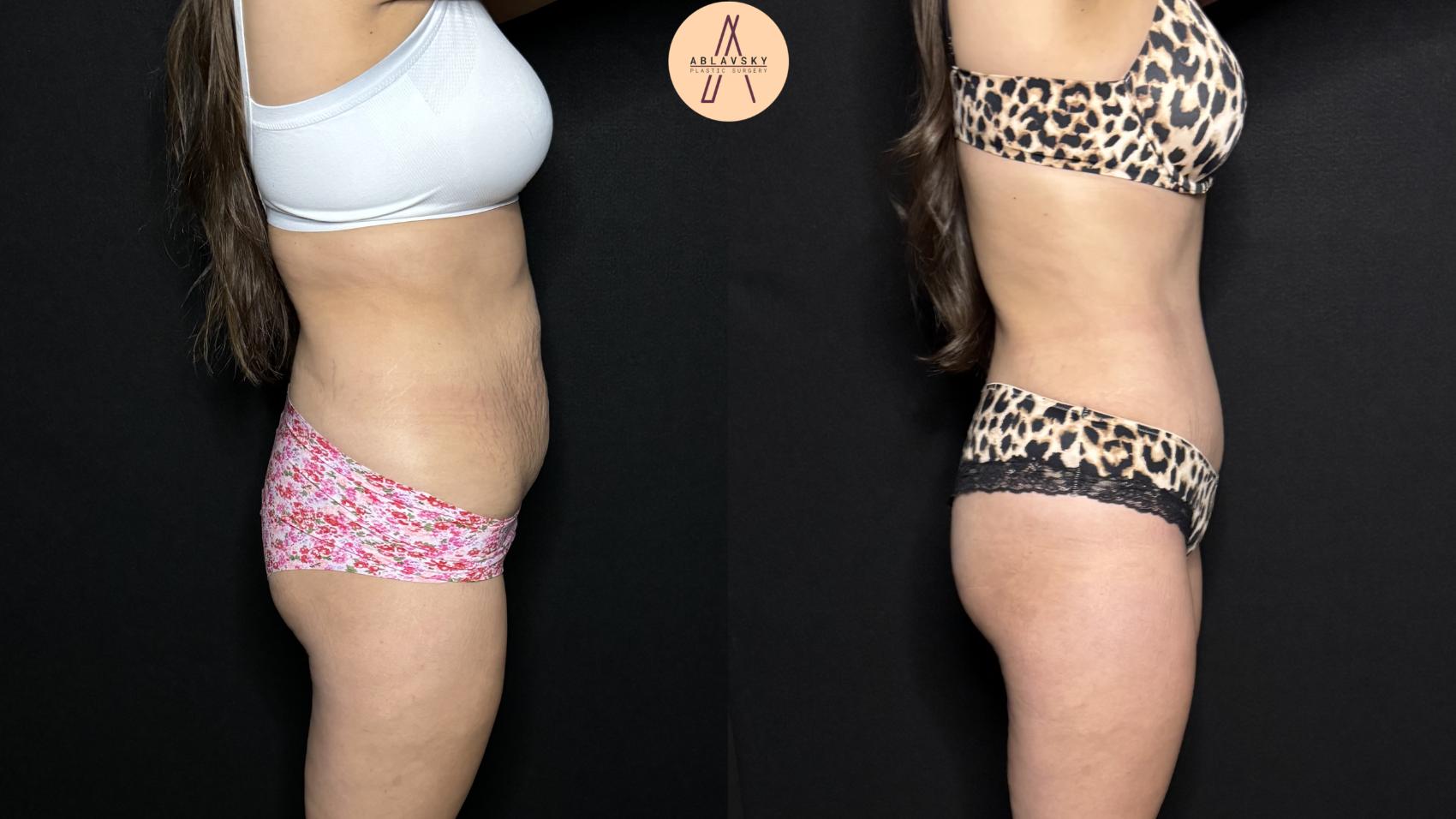 Before & After Tummy Tuck Case 305 Right Side View in San Antonio, Texas