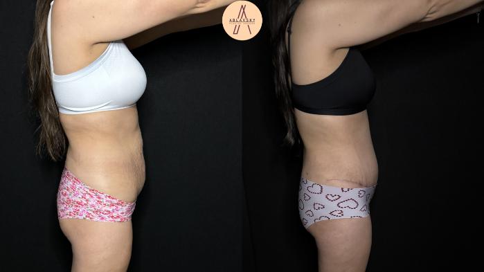 Before & After Tummy Tuck Case 305 Right Side View in San Antonio, Texas