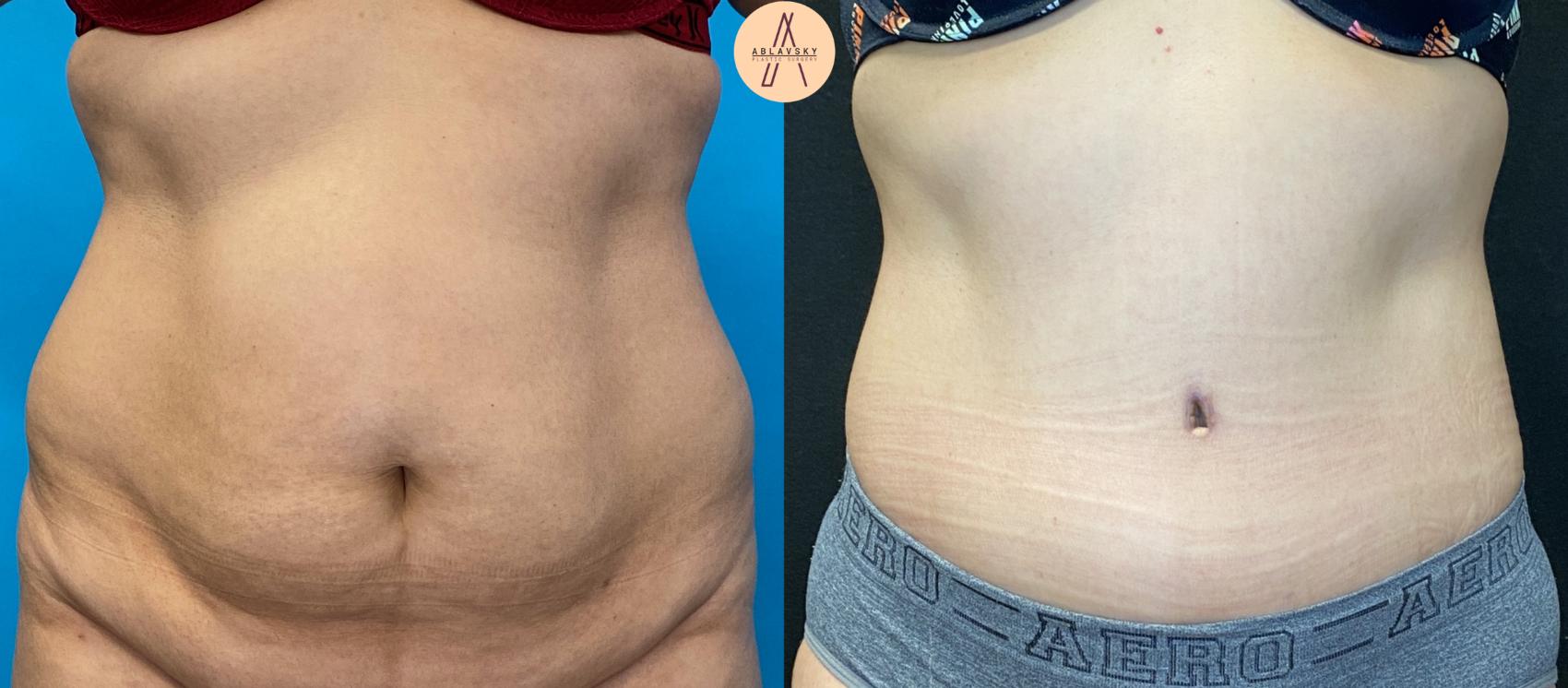 Before & After Tummy Tuck Case 32 Front View in San Antonio, Texas