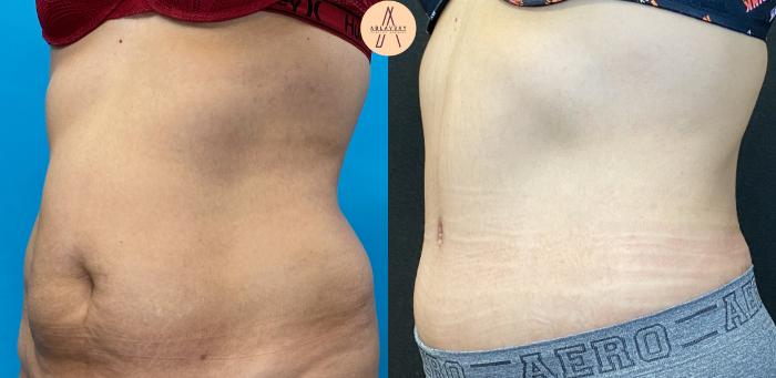 Before & After Tummy Tuck Case 32 Left Oblique View in San Antonio, Texas