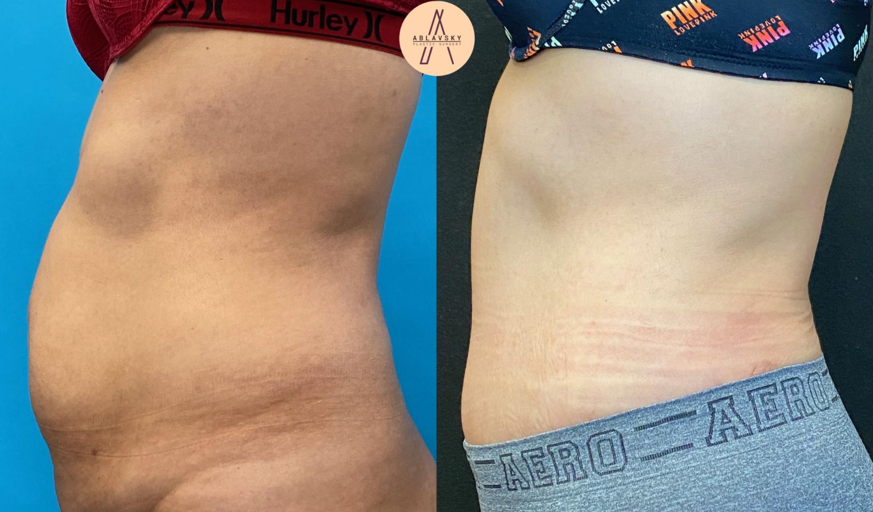 Before & After Tummy Tuck Case 32 Left Side View in San Antonio, Texas